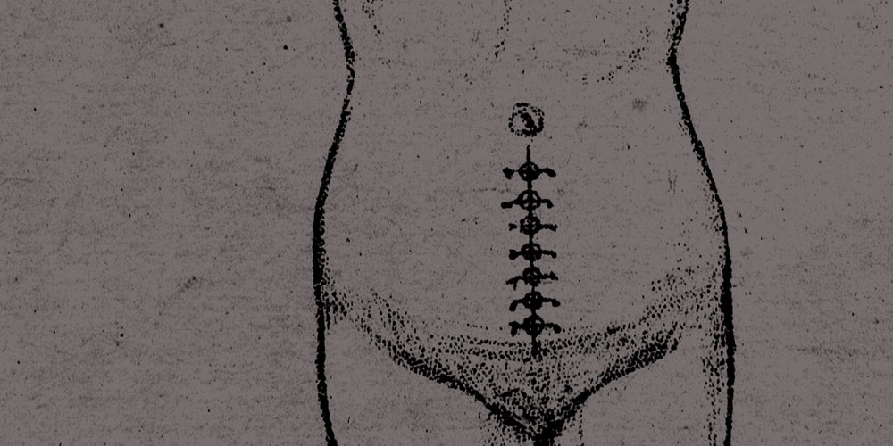 Drawing of a woman's torso with stitches after a c-section.